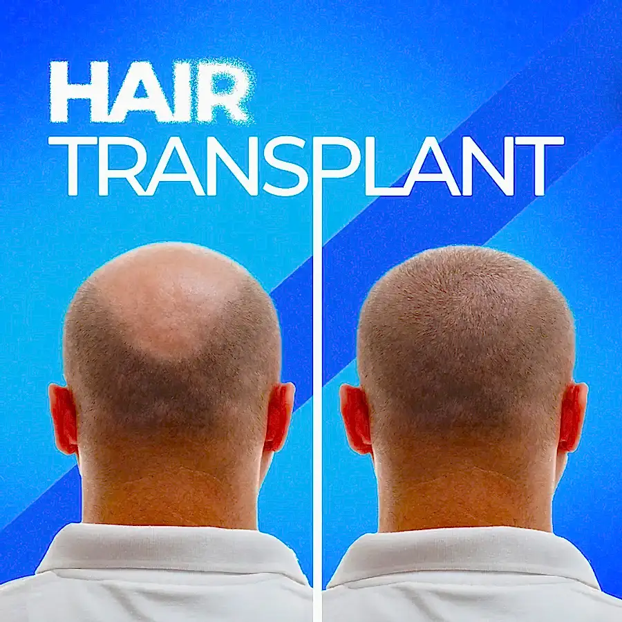 kök hücre ile saç ekimi